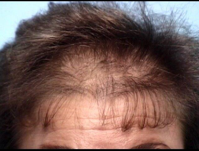 can minoxidil regrow temple hair